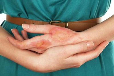 Ngăn ngừa sẹo do bỏng bằng công nghệ pIRE